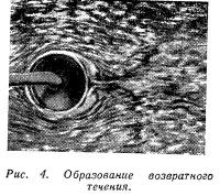 Рис. 4. Образование возвратного течения