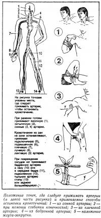 Положение точек, где следует прижимать артерии