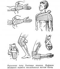 Различные типы бинтовых повязок